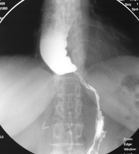 Ахалазия пищевода кардии лечение