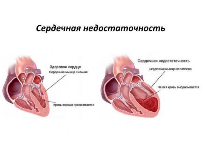 Кашель при сердечной недостаточности симптомы