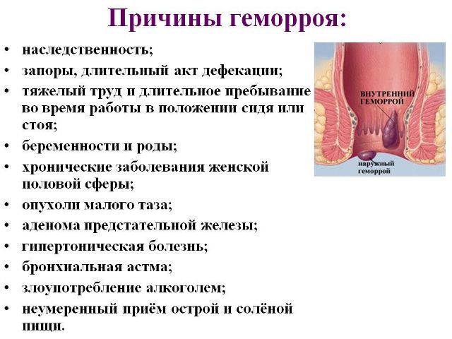 Геморрой.