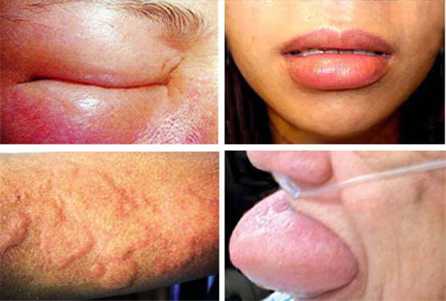 Симптомы отека горла и его лечение