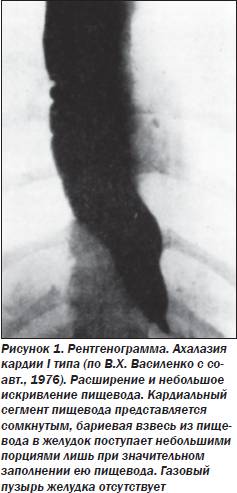 Ахалазия кардии, кардиоспазм пищевода: классификация, симптомы, диагностика, лечение