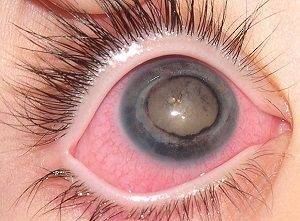 Красные нижние веки у ребенка