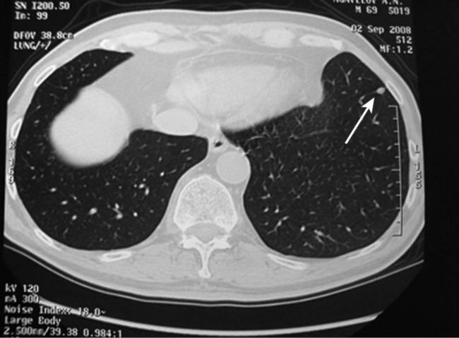 Полиморфные очаги в легких что это