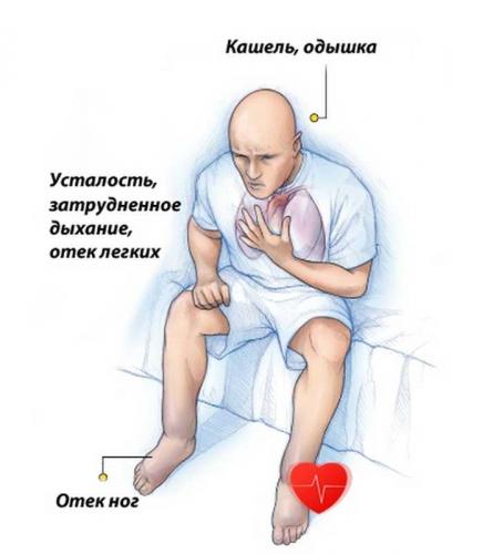Сердечный кашель: причины, симптомы и лечение