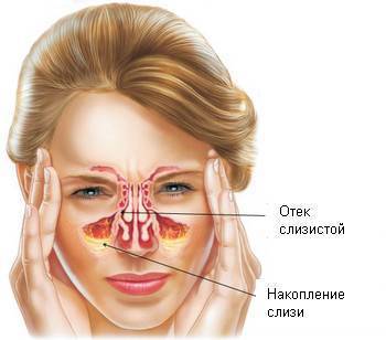 Лечение гайморита в домашних условиях у взрослых: антибиотики и народные средства