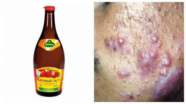 Диета на основе яблочного уксуса отзывы