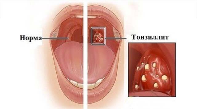 Симптомы отека горла и его лечение