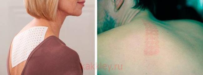 Перцовый пластырь при лечении бронхита