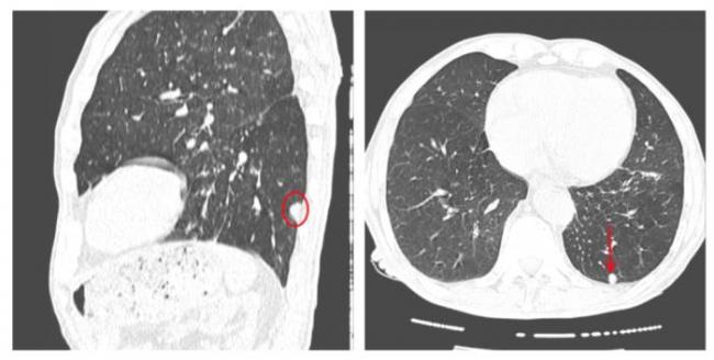 Расшифровка кт органов грудной клетки - вопрос пульмонологу - 03 онлайн
