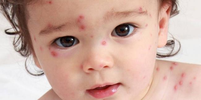 Циндол при ветрянке у детей: показания и инструкция