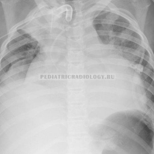 Ателектаз легких у детей