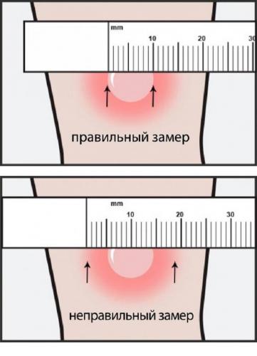 Манту и диаскинтест: что нужно знать родителям