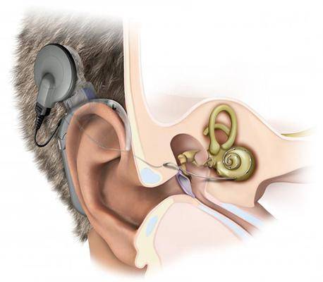 Неврит слухового нерва: симптомы, лечение