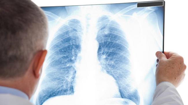 Пневмония у новорожденных и недоношенных детей: симптомы, прогноз, причины, лечение