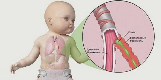 Бронхит у ребенка лечение народными средствами в домашних условиях