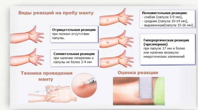Что лучше и безопаснее диаскинтест или манту