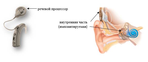 Нейросенсорная тугоухость (кохлеарный неврит)