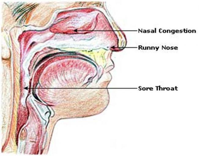 10 проверенных способов быстро избавиться от слизи в горле