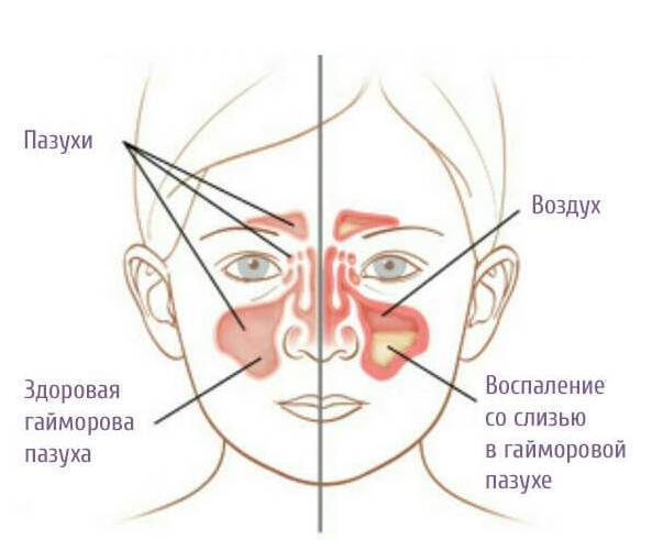 Причины появления выделений из носа