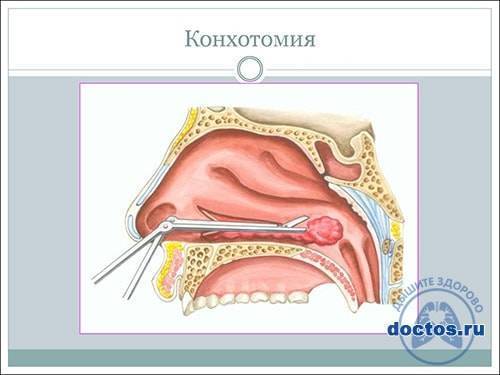 Как использовать сок каланхоэ для лечения насморка детям
