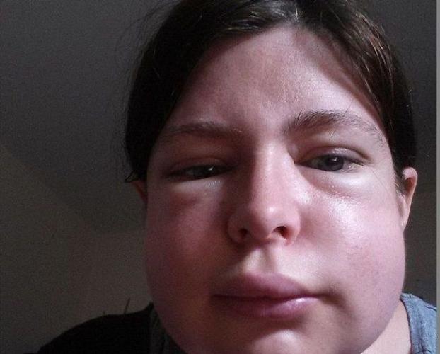 Ангионевротический отек: принципы диагностики и терапии