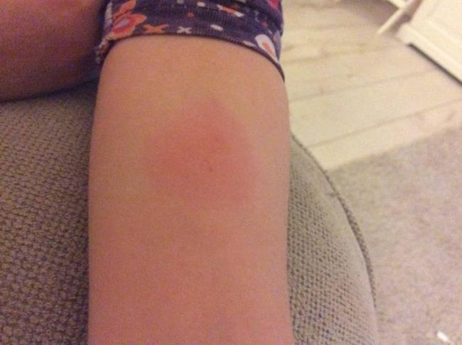 Что делать если у ребенка после манту поднялась температура