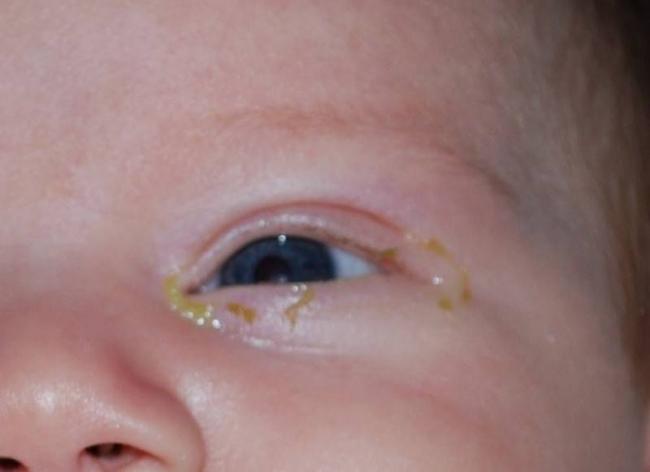 Бактериальный конъюнктивит глаз лечение у взрослых капли