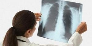 Пневмосклероз