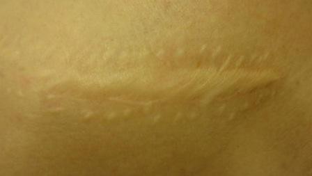 Дерматикс (мазь, гель)