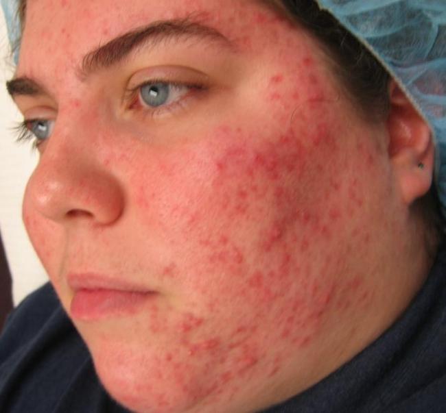 Фукорцин – показания и инструкция по применению раствора при болезнях ногтей, грибке, ветрянке у детей и т.д. аналоги, отзывы, цена препарата. чем отмыть фукорцин?