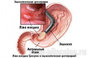 Хеликобактер пилори: симптомы, лечение, профилактика и диета