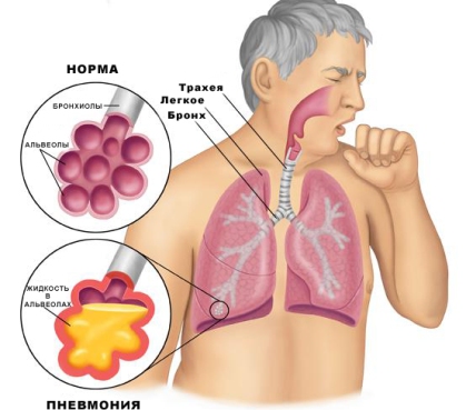 Пневмосклероз легких - что это такое?
