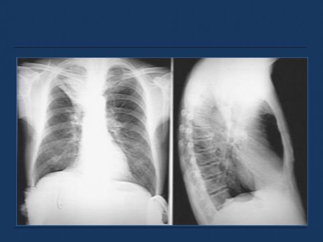 Ателектаз легких: причины, формы, признаки, диагностика, как лечить