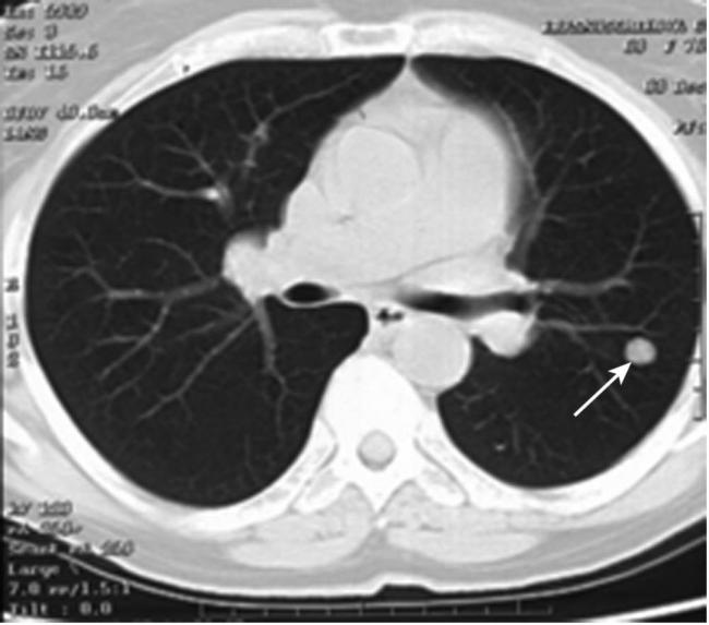 Помогите расшифровать данные кт легких - вопрос пульмонологу - 03 онлайн