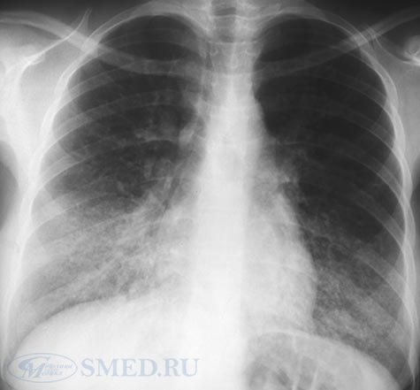 Пневмония у новорожденных - симптомы, лечение, причины, последствия