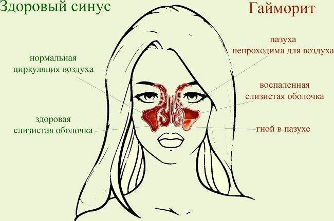 Желтые сопли: о чем говорят, этиологические причины, диагноз, как лечить