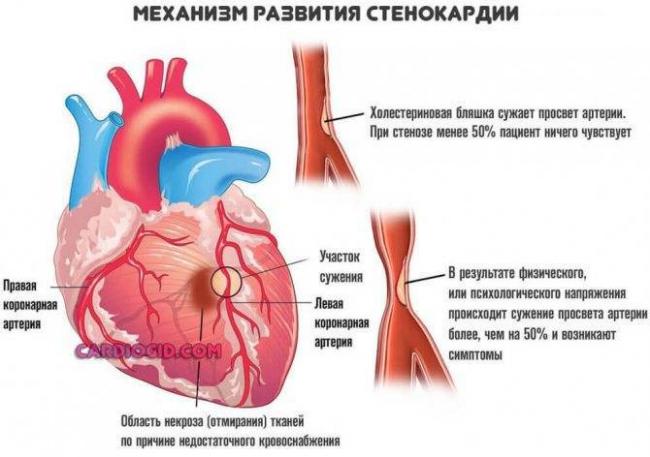 Как лечить одышку при сердечной недостаточности?