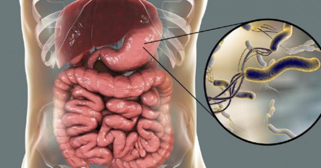 Почему лечение от хеликобактера вредно для здоровья - часть 2