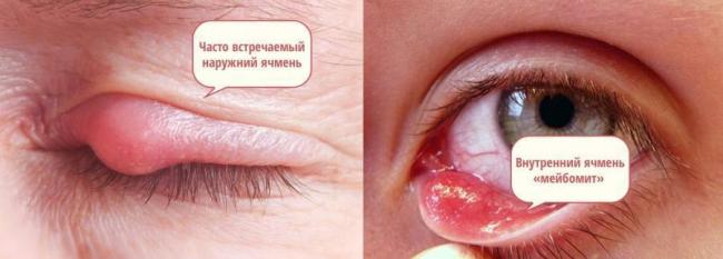 Бактериальный конъюнктивит глаз лечение у взрослых капли