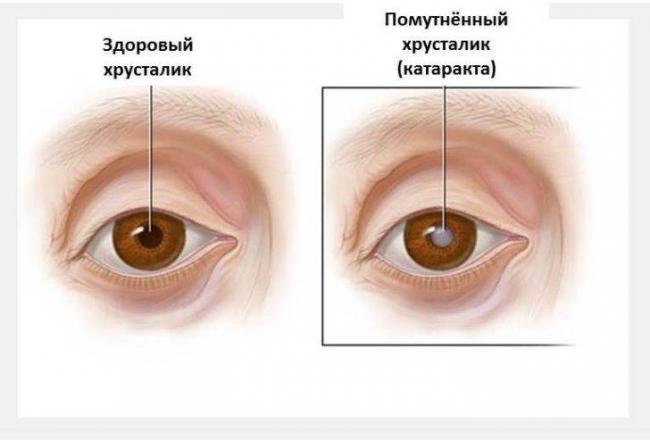 Мультифокальные торические иол