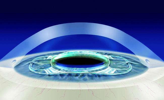 Интраокулярные линзы (иол): особенности, материалы изготовления