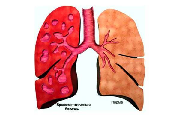 Лечение сильного кашля у взрослых народными средствами