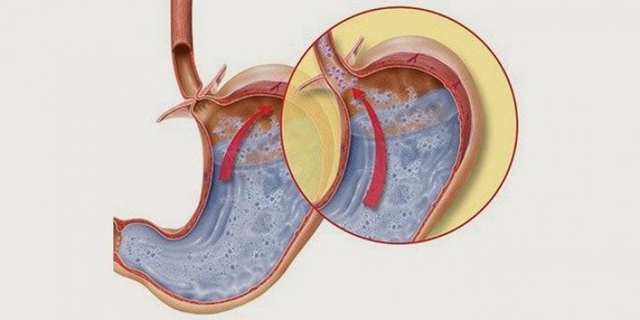 Дуоденогастральный рефлюкс: симптомы дгр, лечение