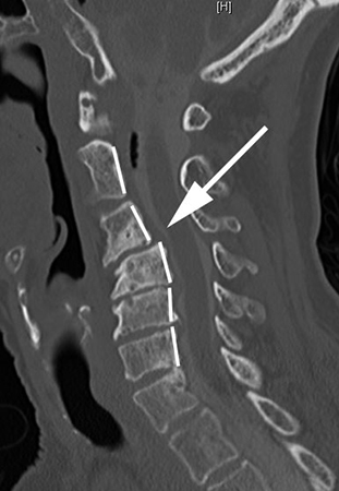 Спондилолистз смещение позвонков пояснично-крестцового отдела позвоночника симптомы