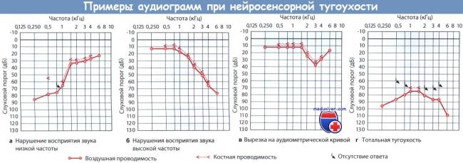 Неврит слухового нерва: симптомы, лечение