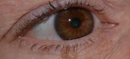 Папиллома на веке удаление народными средствами