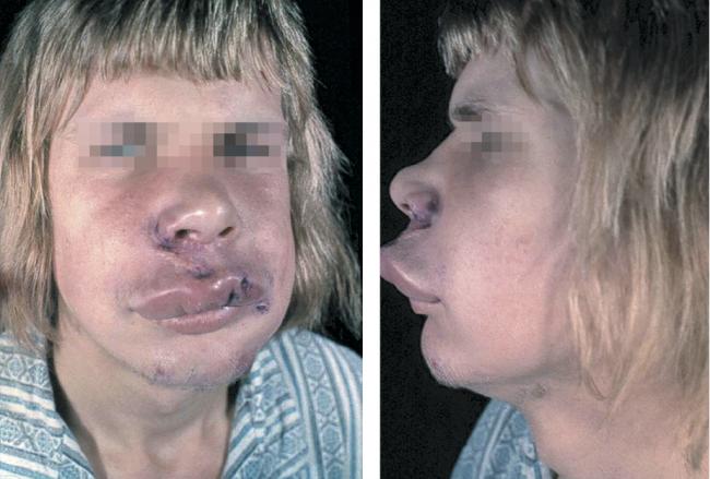 Отек квинке