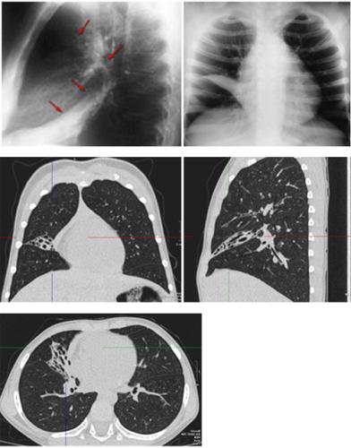Ателектаз легкого: виды, причины, симптомы и лечение — симптомы