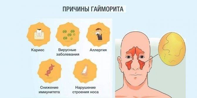 Баня при гайморите: как правильно париться