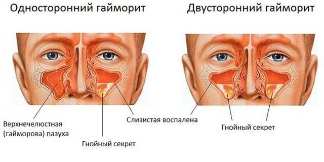 Прогревание носа солью при гайморите